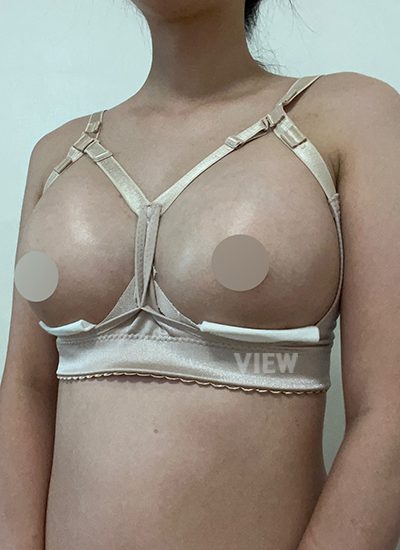 Breast Augmentation, Breast Enlargement Surgery, Breast surgery, Breast augmentation surgery, Mentor review, Breast surgery clinic, Mentor implants, Mentor Xtra Smooth, Breast implants
