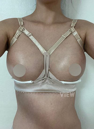 Breast Augmentation, Breast Enlargement Surgery, Breast surgery, Breast augmentation surgery, Mentor review, Breast surgery clinic, Mentor implants, Mentor Xtra Smooth, Breast implants