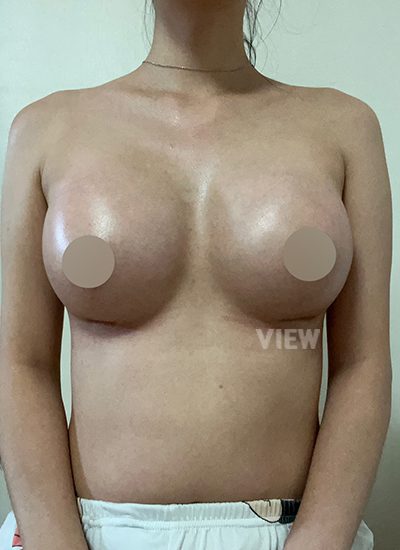 Review at View Plastic Surgery, Plastic Surgery in Korea, View Clinic, Korea Clinic