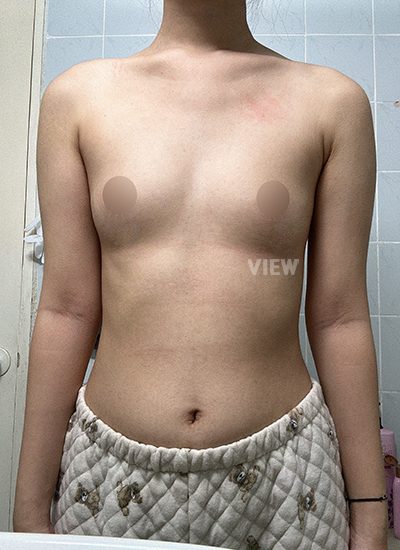 Breast Augmentation, Breast Enlargement Surgery, Breast surgery, Breast augmentation surgery, Mentor review, Breast surgery clinic, Mentor implants, Mentor Xtra Smooth, Breast implants 