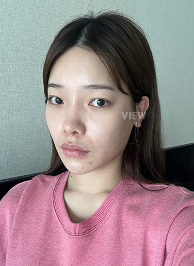 View Plastic Surgery Review, Facial Contouring, Korean Plastic Surgery Clinic Consultation, Cheekbone Reduction Price, Jawline Reduction Price 