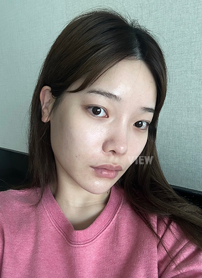 View Plastic Surgery Review, Facial Contouring, Korean Plastic Surgery Clinic Consultation, Cheekbone Reduction Price, Jawline Reduction Price 