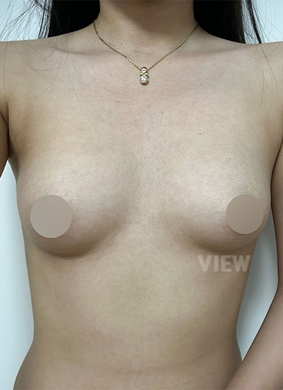 Review at View Plastic Surgery, Plastic Surgery in Korea, View Clinic, Korea Clinic 