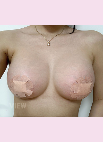 Review at View Plastic Surgery, Plastic Surgery in Korea, View Clinic, Korea Clinic 