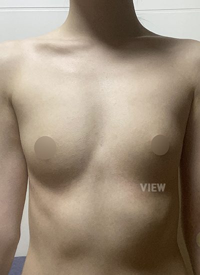 Review at View Plastic Surgery, Plastic Surgery in Korea, View Clinic, Korea Clinic 