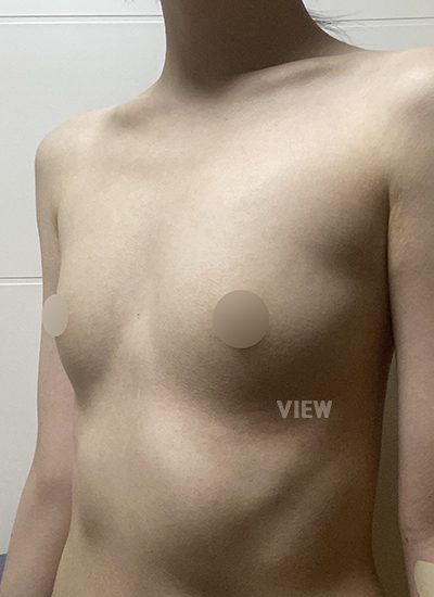 Review at View Plastic Surgery, Plastic Surgery in Korea, View Clinic, Korea Clinic 