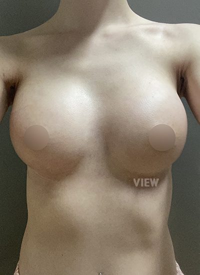 Review at View Plastic Surgery, Plastic Surgery in Korea, View Clinic, Korea Clinic 