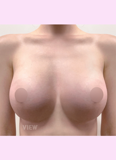 Breast Augmentation, Breast Enlargement Surgery, Breast surgery, Breast augmentation surgery, Mentor review, Breast surgery clinic, Mentor implants, Mentor Xtra Smooth, Breast implants 