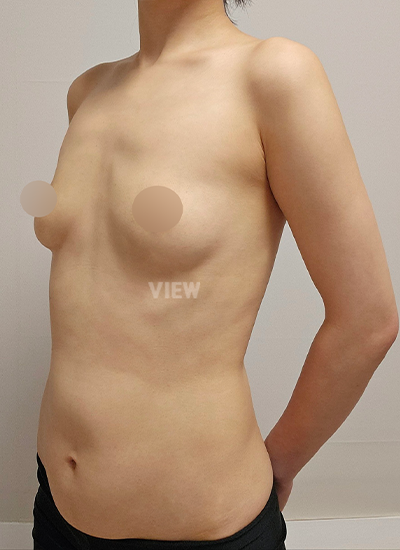 Breast Augmentation, Breast Enlargement Surgery, Breast surgery, Breast augmentation surgery, Mentor review, Breast surgery clinic, Mentor implants, Mentor Xtra Smooth, Breast implants 