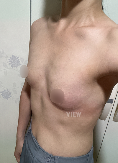 Breast Augmentation, Breast Enlargement Surgery, Breast surgery, Breast augmentation surgery, Mentor review, Breast surgery clinic, Mentor implants, Mentor Xtra Smooth, Breast implants 