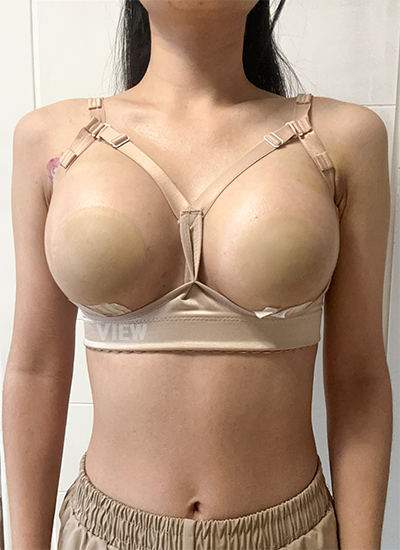 Breast Augmentation, Breast Enlargement Surgery, Breast surgery, Breast augmentation surgery, Mentor review, Breast surgery clinic, Mentor implants, Mentor Xtra Smooth, Breast implants 