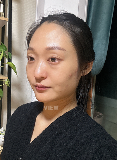 Review at View Plastic Surgery, Plastic Surgery in Korea, View Clinic, Korea Clinic 