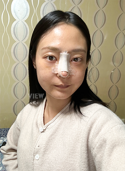 Double eyelid surgery, Non-incisional eyelid surgery 