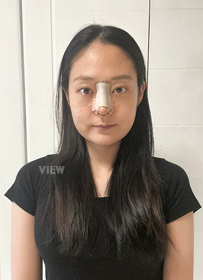 Double eyelid surgery, Non-incisional eyelid surgery 