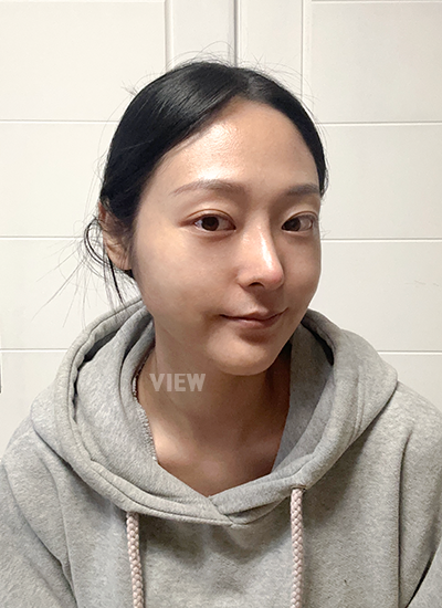 Double eyelid surgery, Non-incisional eyelid surgery 