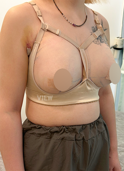 Breast Augmentation, Breast Enlargement Surgery, Breast surgery, Breast augmentation surgery, Mentor review, Breast surgery clinic, Mentor implants, Mentor Xtra Smooth, Breast implants 