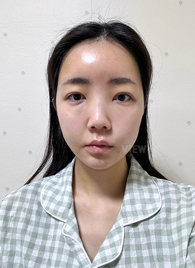 Thread Lift,Fat Graft, Face Liposuction, Botox 