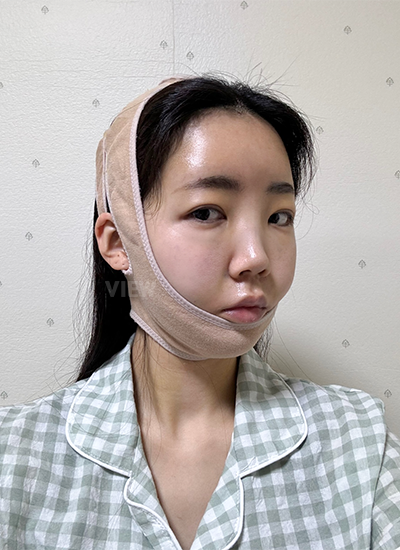 Thread Lift,Fat Graft, Face Liposuction, Botox 