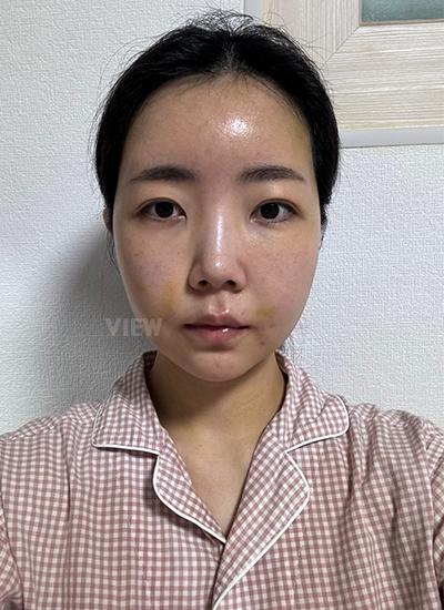 Thread Lift,Fat Graft, Face Liposuction, Botox 