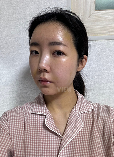 Thread Lift,Fat Graft, Face Liposuction, Botox 