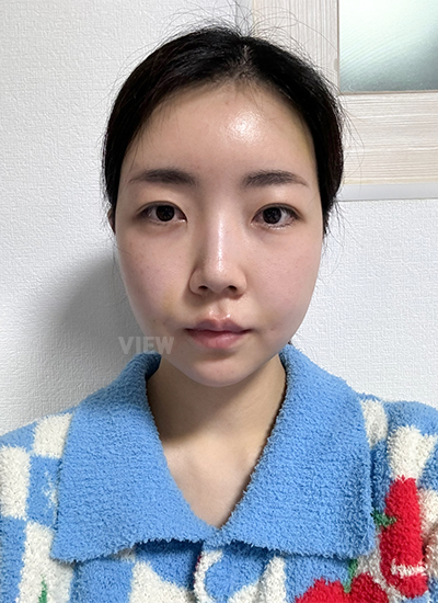 Review at View Plastic Surgery, Plastic Surgery in Korea, View Clinic, Korea Clinic 