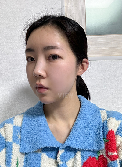 Review at View Plastic Surgery, Plastic Surgery in Korea, View Clinic, Korea Clinic 