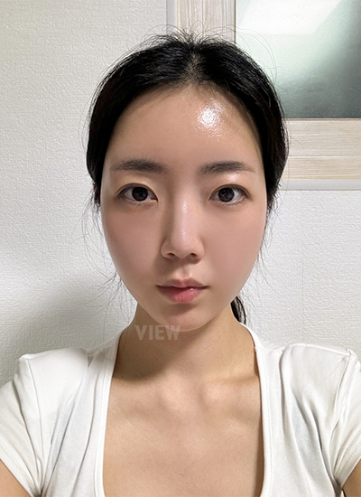 Thread Lift,Fat Graft, Face Liposuction, Botox 