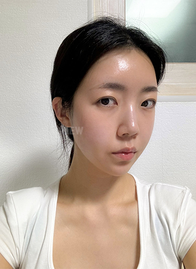 Review at View Plastic Surgery, Plastic Surgery in Korea, View Clinic, Korea Clinic 