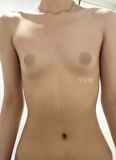 Breast Augmentation, Breast Enlargement Surgery, Breast surgery, Breast augmentation surgery, Mentor review, Breast surgery clinic, Mentor implants, Mentor Xtra Smooth, Breast implants