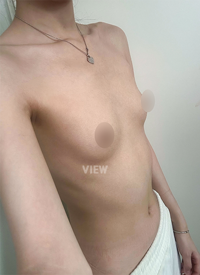 Review at View Plastic Surgery, Plastic Surgery in Korea, View Clinic, Korea Clinic 