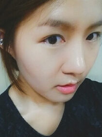 [Natural line rhinoplasty + combination buried (reoperation) + magic anterior slit + posterior slit + lower slit] Jo Hae-ri