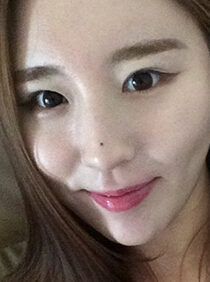 [Eye correction surgery (reoperation) + open back + lower eyelid] Park Kyung-won