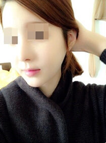[Natural V line + cheekbone reduction + forehead implant] Yunkyung Lee