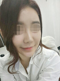 [Doll line (V line) + cheekbone reduction] Kim Ji-won
