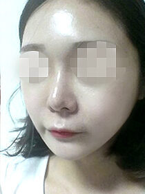 [Clown reduction surgery] Han Ye-ju