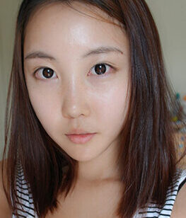 [V-line + cheekbone reduction + T.O.P rhinoplasty (reoperation) + facial fat grafting] Kim Soo-young