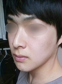 [Natural V line + square jaw reduction + front jaw surgery] Taeha Kang