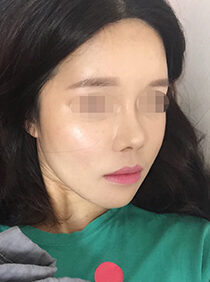 [Square chin reduction + front chin surgery] Jihye Kim