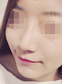 [rhinoplasty (nose bridge + tip of nose)] Kim Kyung-wha
