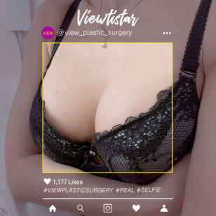 [Breast Augmentation] Kim Nagyeong
