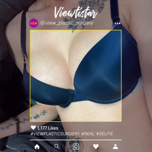 [Breast Augmentation] Kim Jeonga