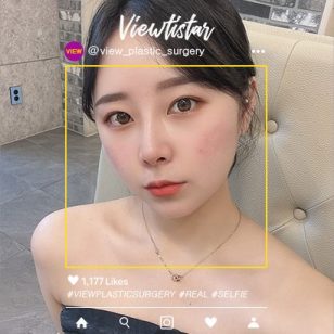 [Double eyelid surgery + Rhinoplasty + Fat graft surgery (full face) + Liposuction (double chin)] An Hyeongyeong