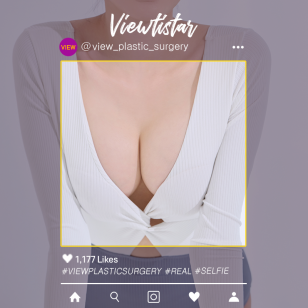 [Breast Augmentation (Motiva)] Hong Jua