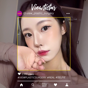 [Rhinoplasty] Kim Jia