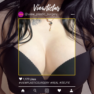 [Breast Augmentation(Motiva)] Kim Dayeon