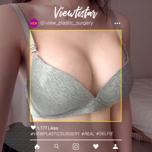 [Breast Augmentation(Motiva)] Kim Sunmi