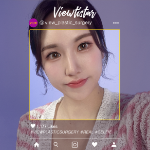 [Double Eyelid Surgery revision + Rhinoplasty] Jeong Miseon