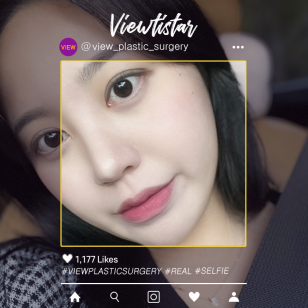 [Double Eyelid Revisional Surgery] Jo Heejoo