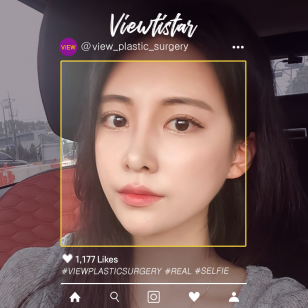 [Double Eyelid Surgery+Rhinoplasty+Fat Graft+Face Liposuction] Kim Jieun