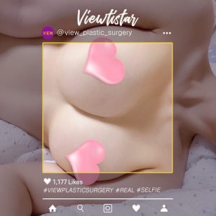 [Breast Augmentation (Motiva] Oh Yumi